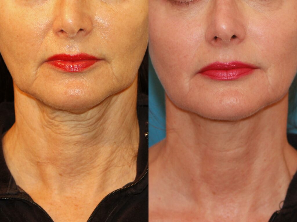 Sculptra Injection A Long Acting Filler Hush LA Medspa