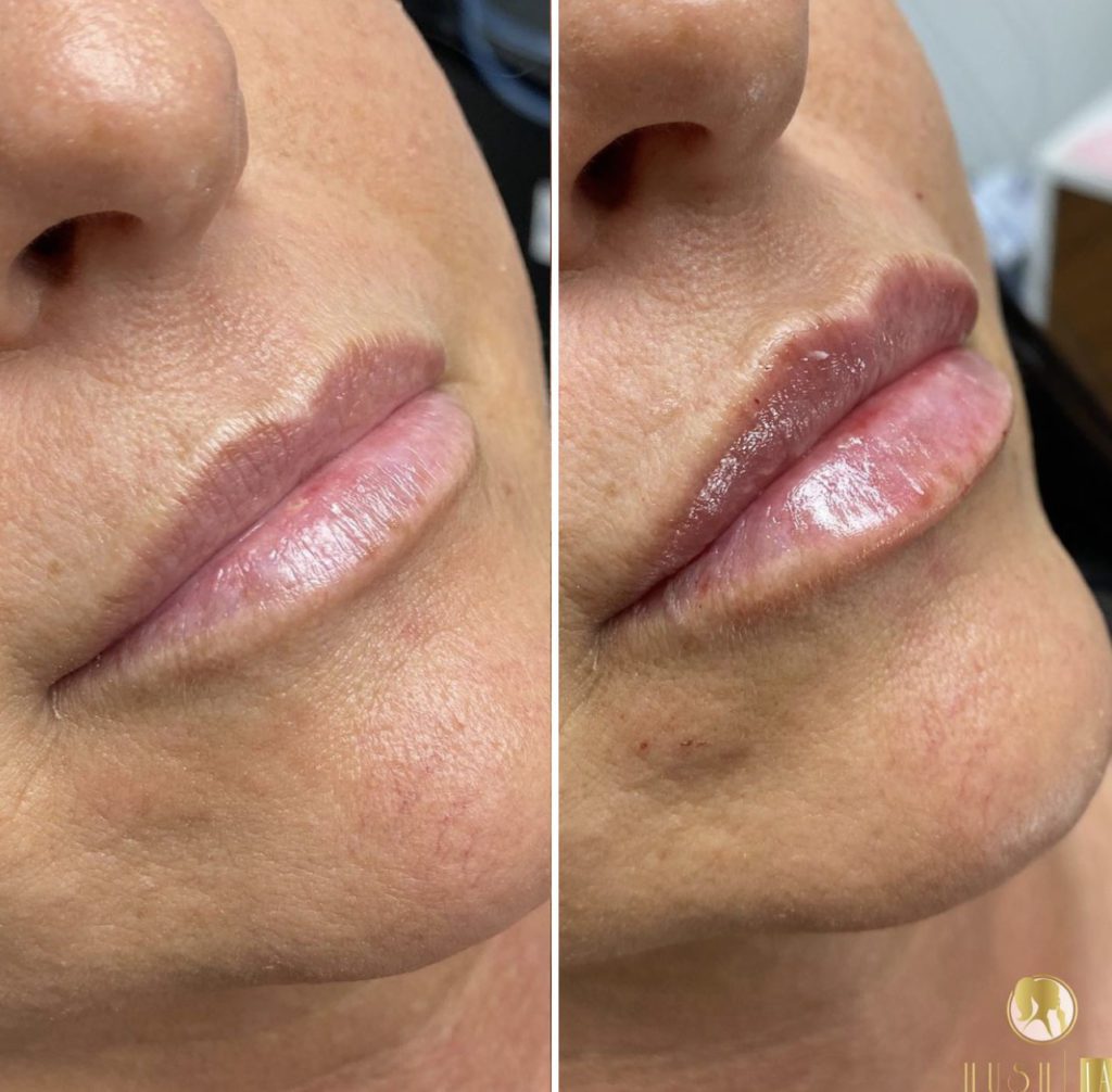 lips dermal filler in Los Angeles