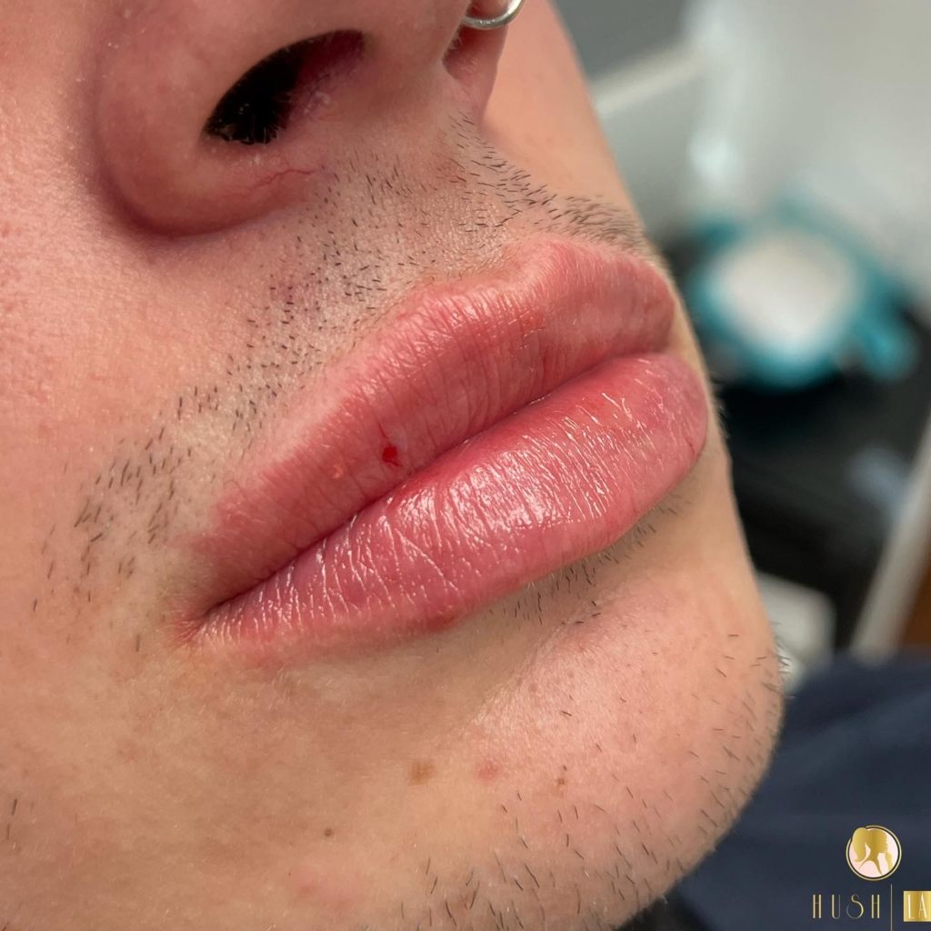 man lips filler