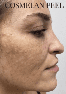 Cosmelan peel chemical peel Los Angeles