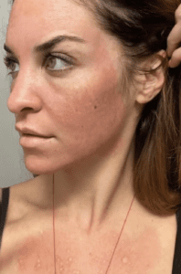 Cosmelan peel results Los Angeles