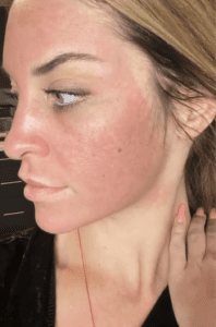 chemical peel treatment results Los Angeles