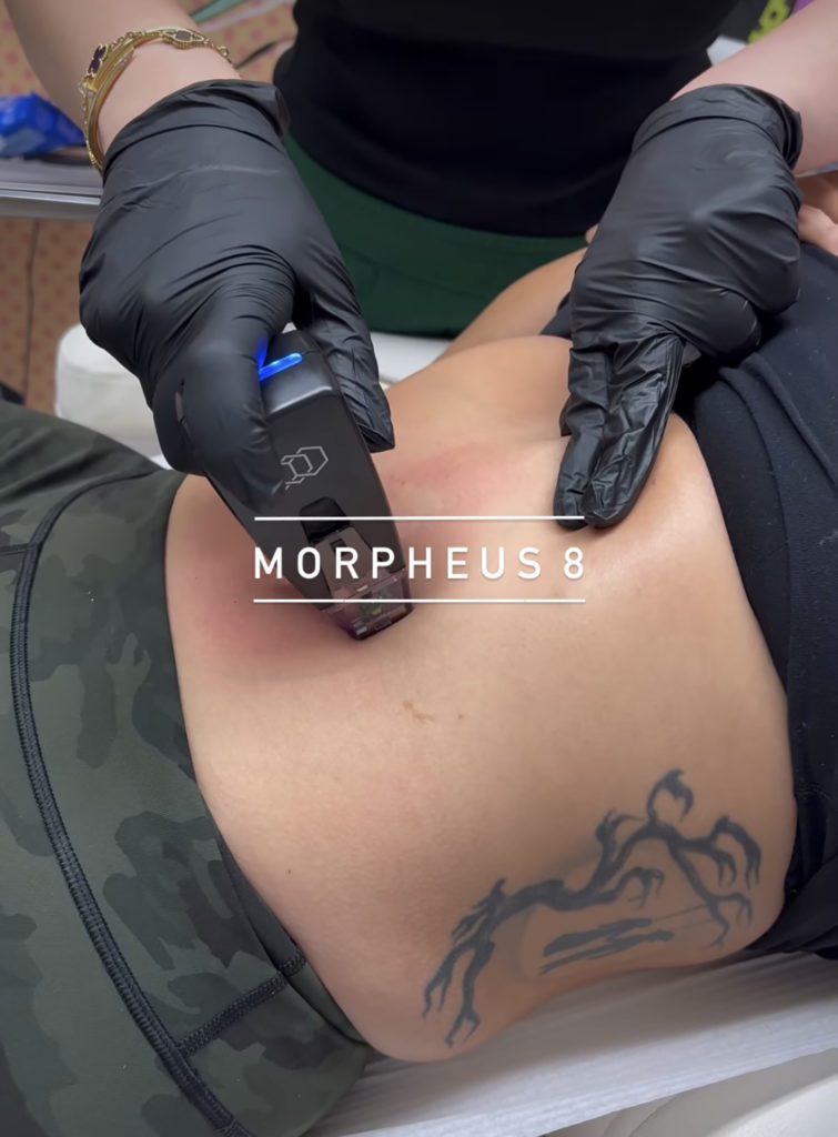 abdomen treatment Morpheus 8 Los Angeles