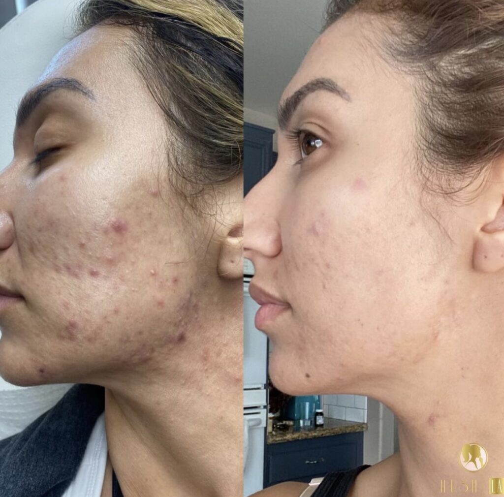 Acne treatment via IPL