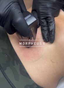 Morpheus8 Los Angeles abdomen treatment