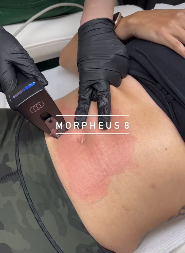 Morpheus8 on abdomen Los Angeles