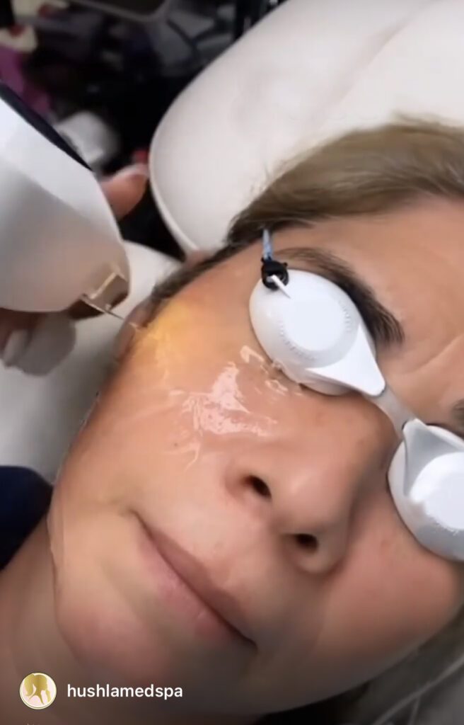 best Lumecca IPL photofacial in Los Angeles