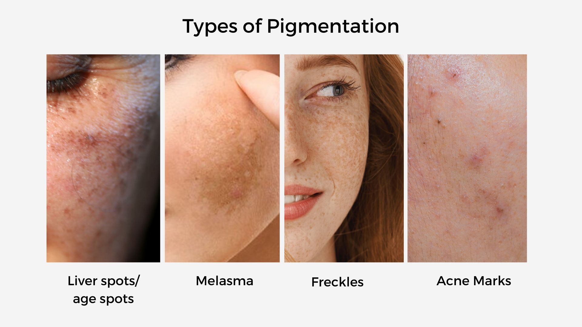 3-best-treatment-for-skin-pigmentation-problem-by-dr-zubin-lybrate