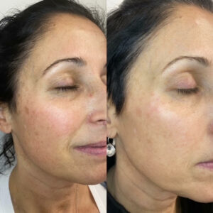 Lumecca IPL for pigmentation treatment Los Angeles