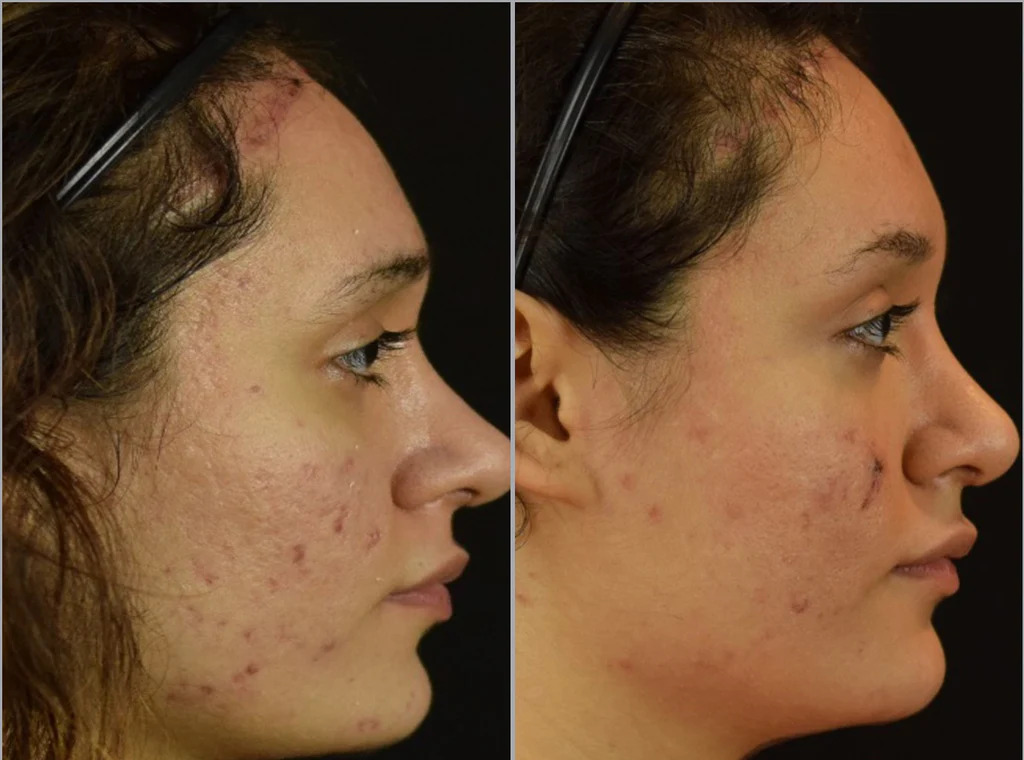 Microneedling For Acne Scars Hush La Medspa