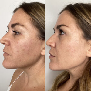 photorejuvenation before and after results