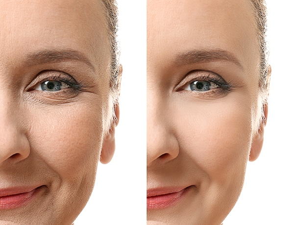 Best non-surgical treatments for face contouring - Hush LA Medspa