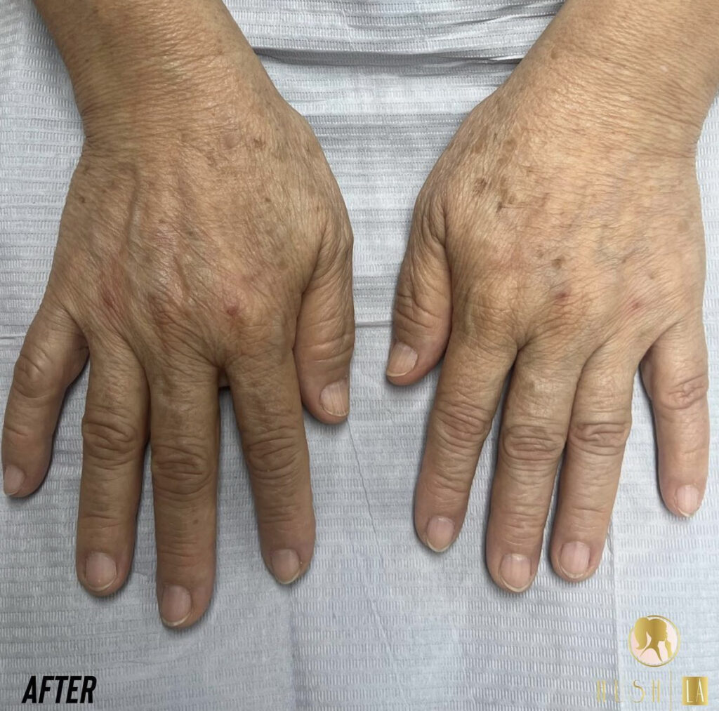 treatment for aging spots on hands after Los Angeles