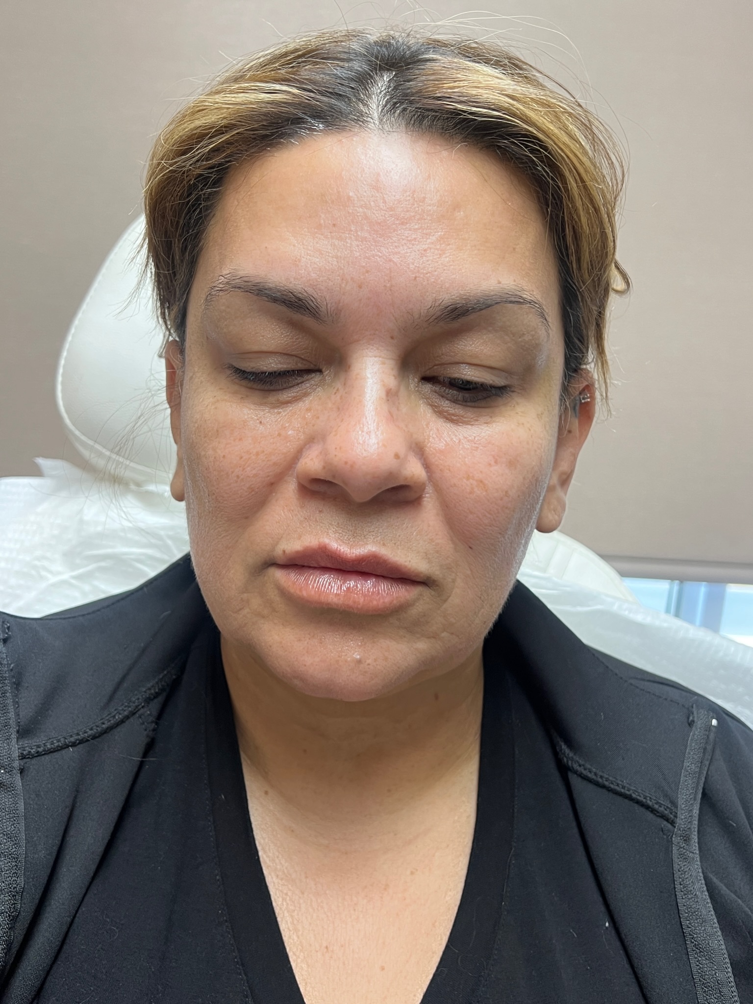 Hush L.A. Medspa - 🧵 Lifting the tip of the nose can make the nose appear  slimmer and more contoured. 🧵 We use PDO threads customized especially for  the nose to lift
