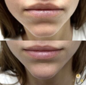 lip fillers Los Angeles