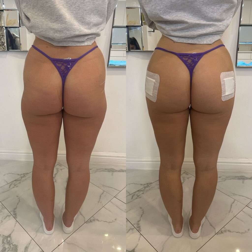 buttocks injections before and after photos