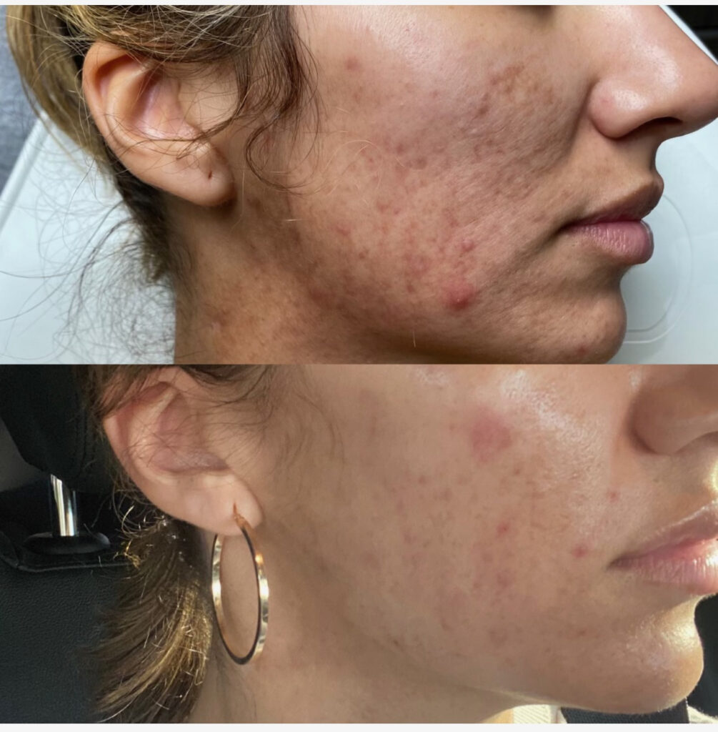 acne treatment with Morpheus 8