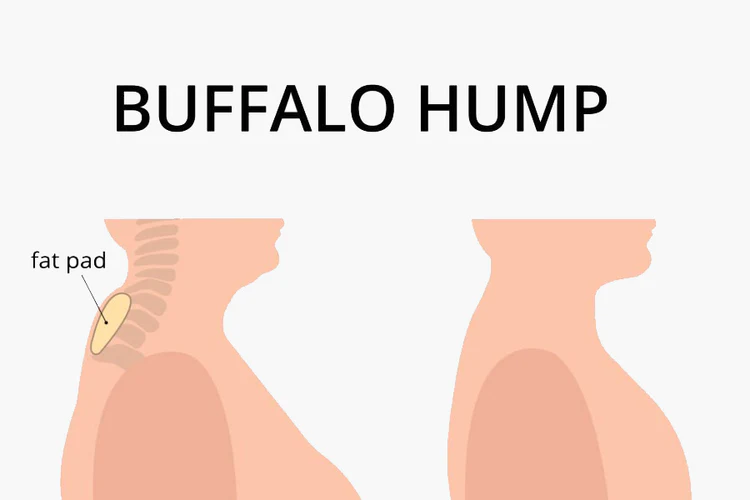 Buffalo Hump: What Is It, Causes, Treatment, and More