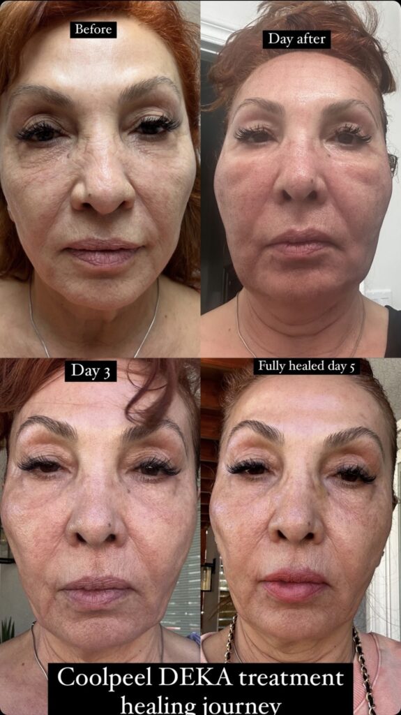 Cool peel laser treatment before and after results