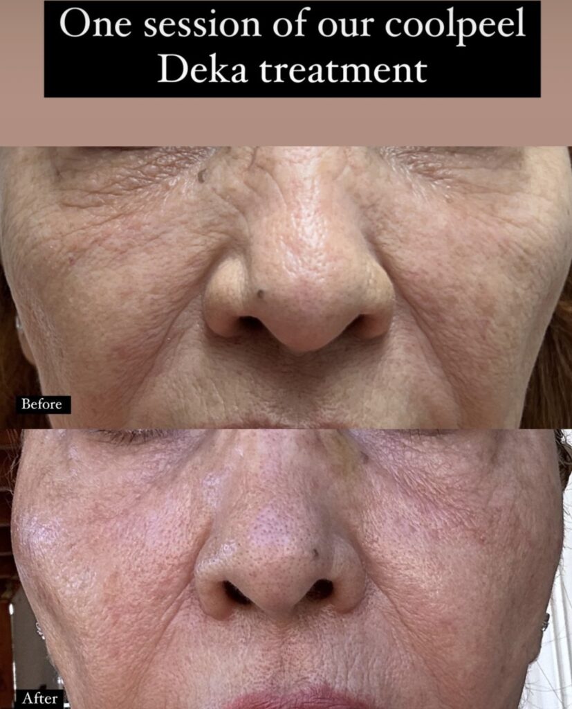 before-after results for coolpeel skin treatment