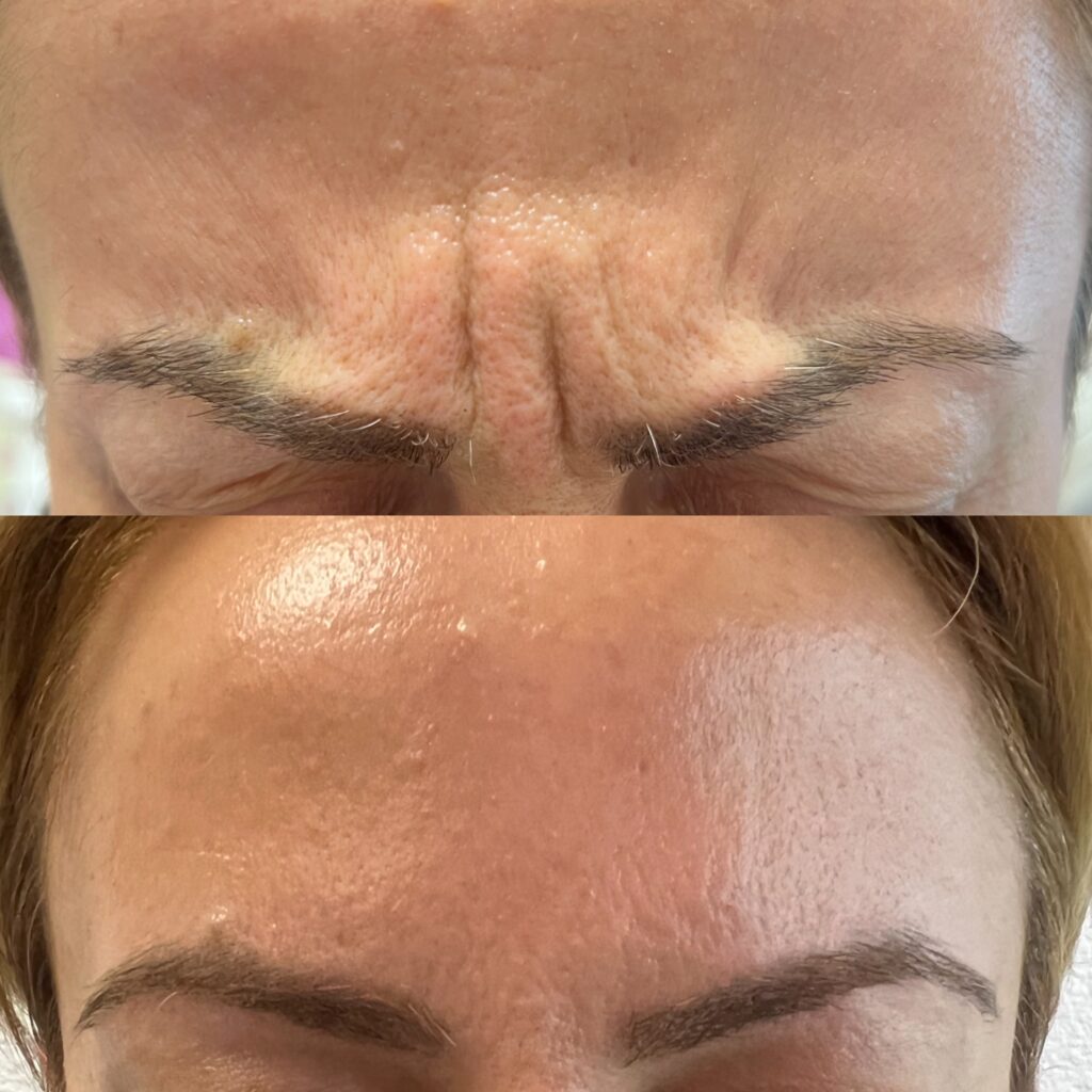botox injection for frown lines