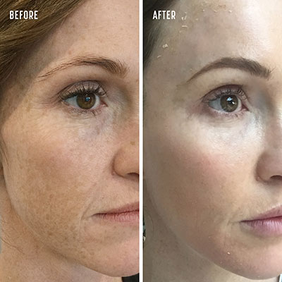 Chemical peels for liver spots before-after Los Angeles