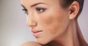 Effective ways to treat liver spots Los Angeles