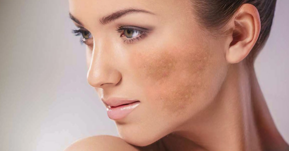 Effective ways to treat liver spots Los Angeles
