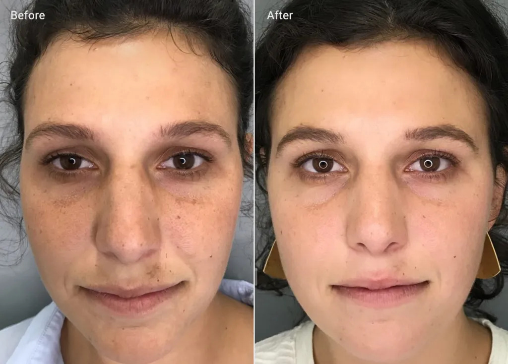 Microneedling before-after Los Angeles