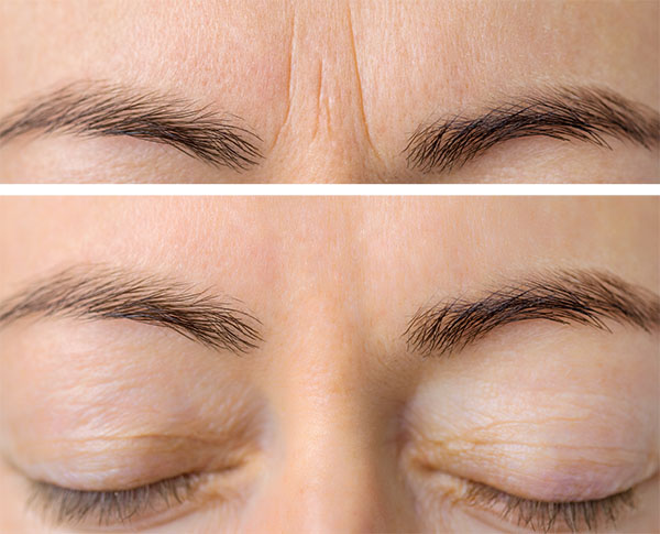 chemical peels before-after Los Angeles