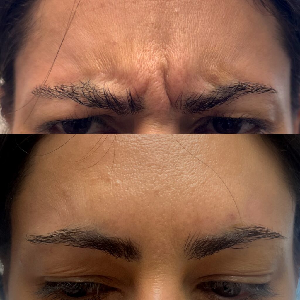 glabella frown lines treatment Los Angeles