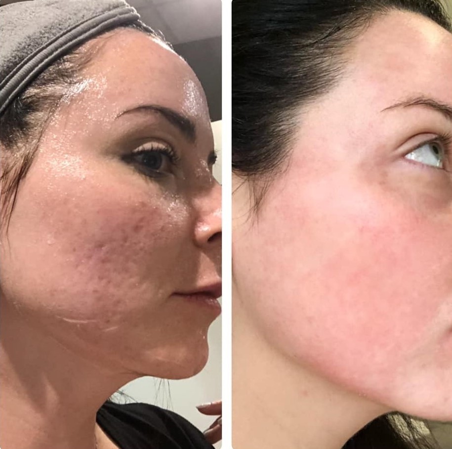 CO2 laser resurfacing before-after Los Angeles