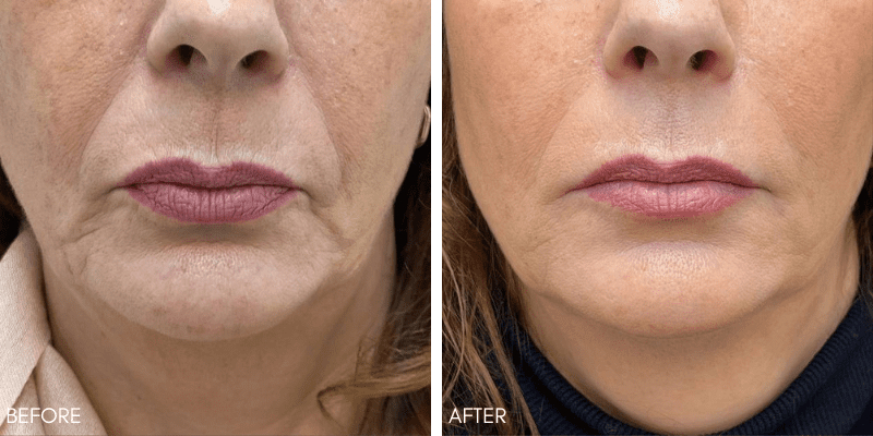 Chemical peels for smile lines before-after Los Angeles