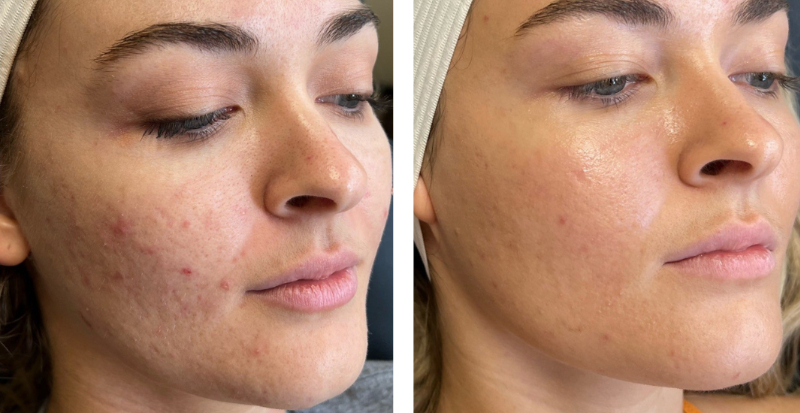 CoolPeel for acne scars treatment before-after Los Angeles