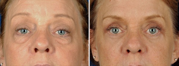 Dark Circles Under the Eyes treatment with Microneedling Los Angeles