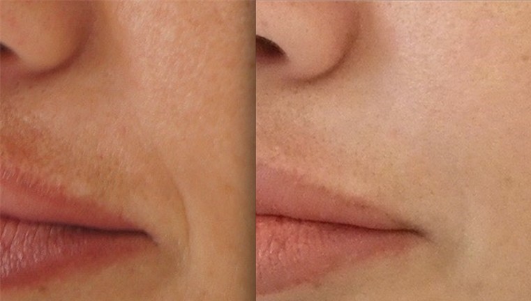 Microneedling before-after nasolabial folds Los Angeles