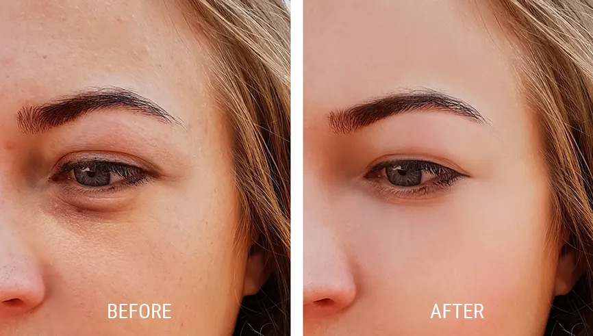 PRP for under eyes before-after Los Angeles