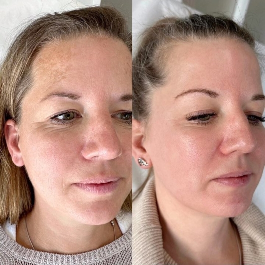Sculptra for cheeks Before After Los Angeles