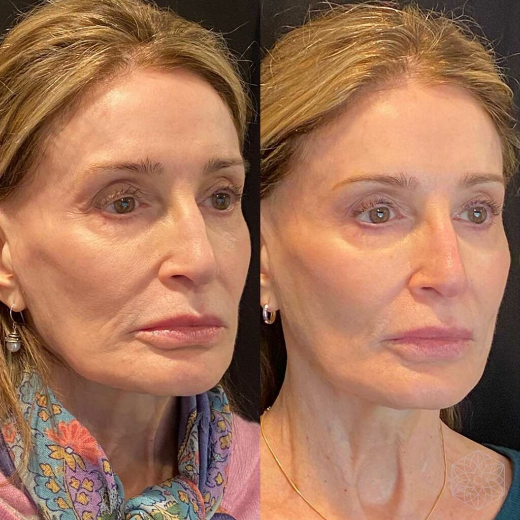Sculptra injections before-after Los Angeles