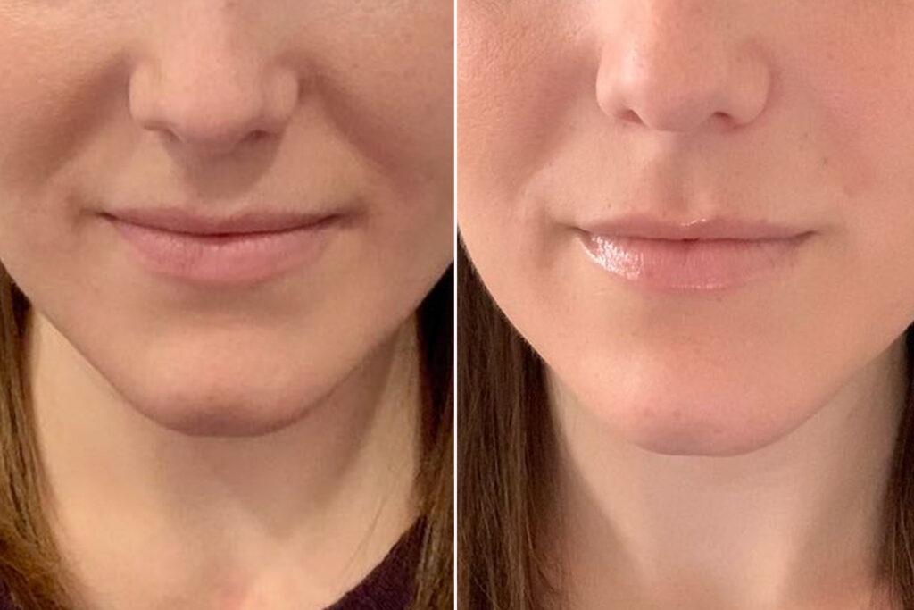 botox for nasolabial folds before and after Los Angeles