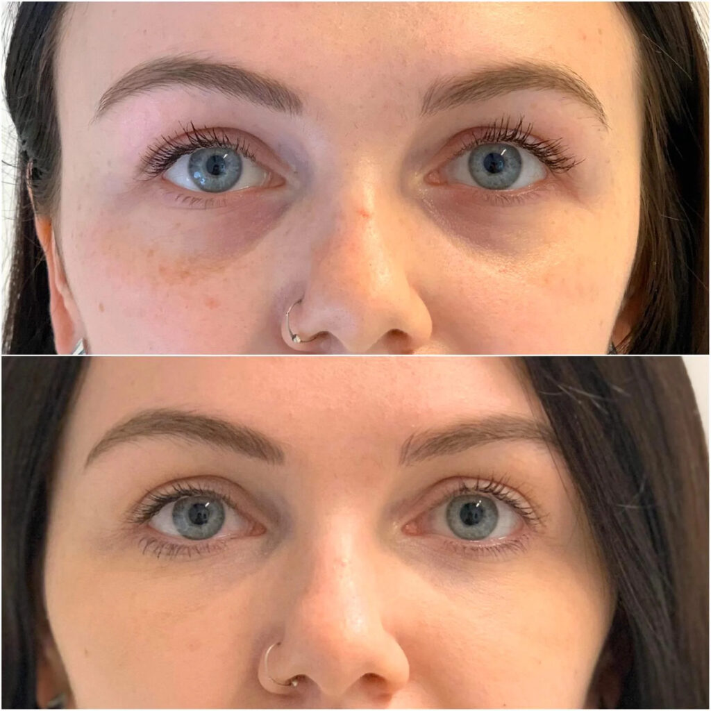 dermal fillers for under-eye hollows before-after Los Angeles
