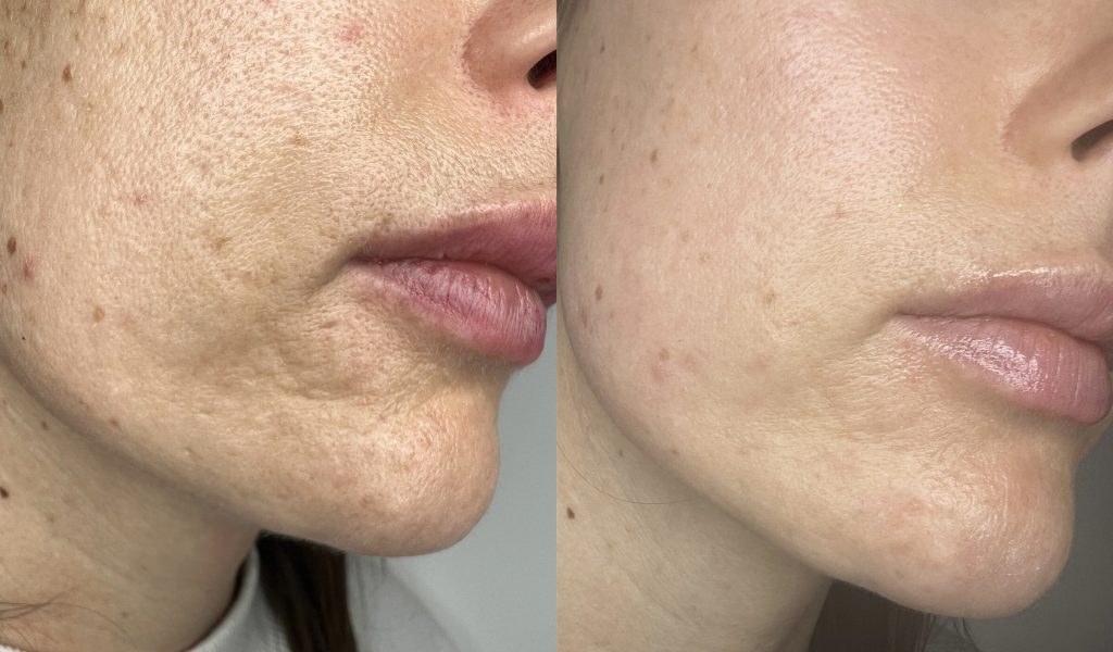 scars treatment with CoolPeel CO2 laser before-after Los Angeles