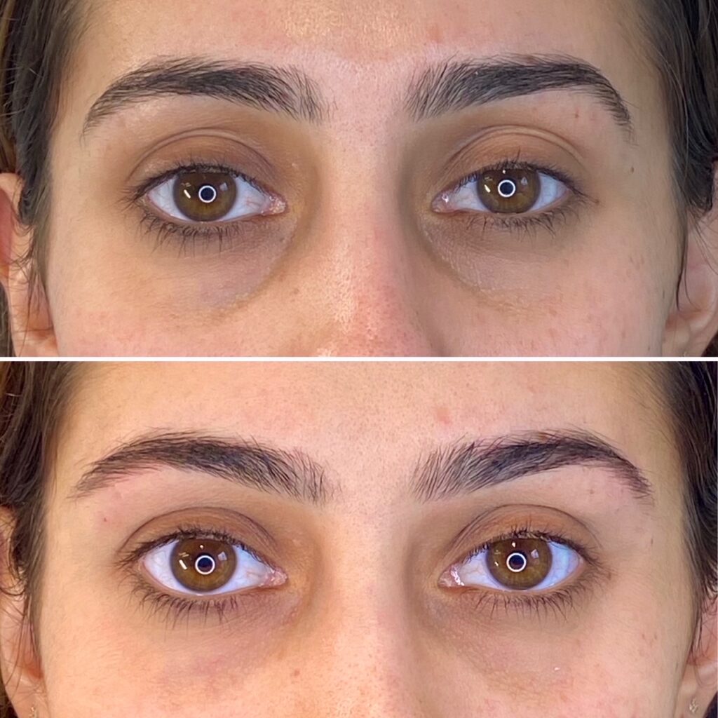 Dermal fillers for foxy eye Los Angeles