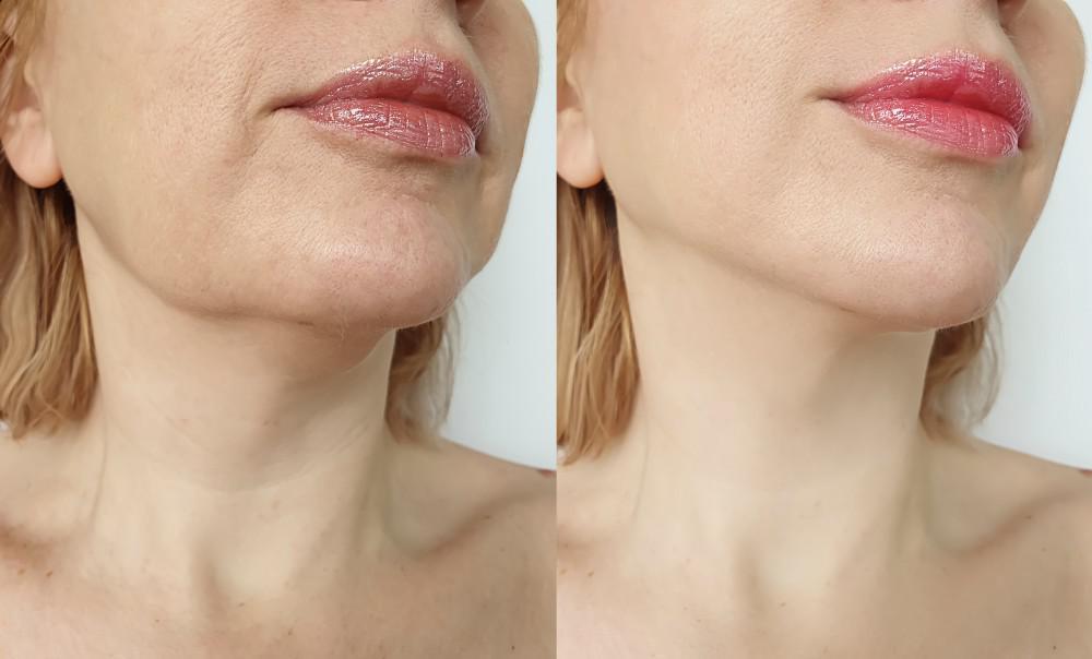 Dermal fillers for skin laxity before-after Los Angeles