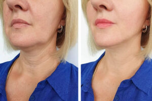 Morpheus8 for neck lift before-after Los Angeles