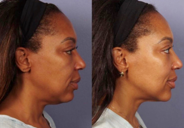 Remove fat in the neck area with Morpheus8 Los Angeles