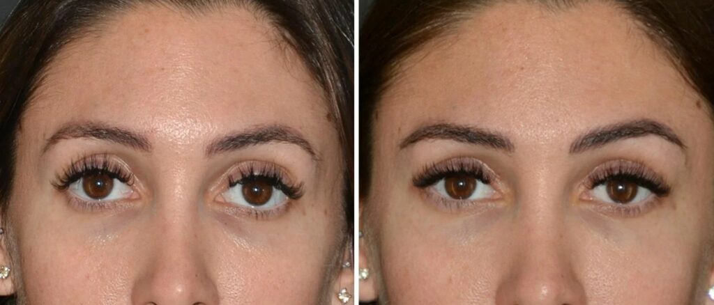 almond eyes lift treatments Los Angeles