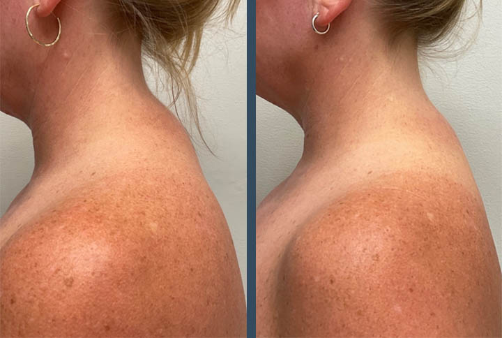 botox injection for slimming shoulders Los Angeles