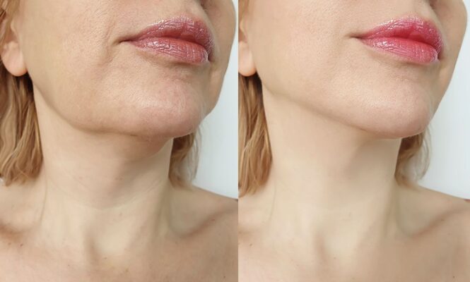 double chin treatment with Morpheus8 Los Angeles
