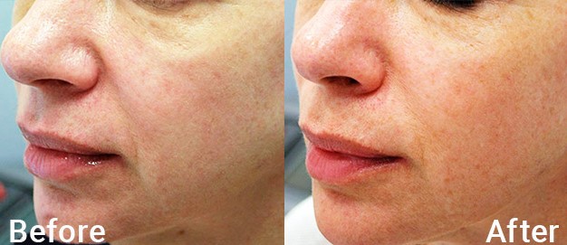 microneedling for skin laxity treatment before-after Los Angeles